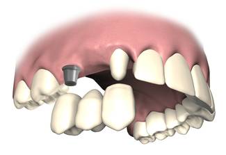 Zahn+Implantat=Hybridbrücke