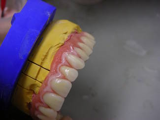 Perfekte Zahnprothese aus dem Dentallabor