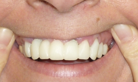 Zahnfarbe a3 5 zu dunkel