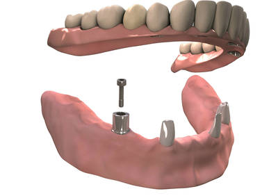 Hybrid-Teleskopkronen Zähne und Implantate