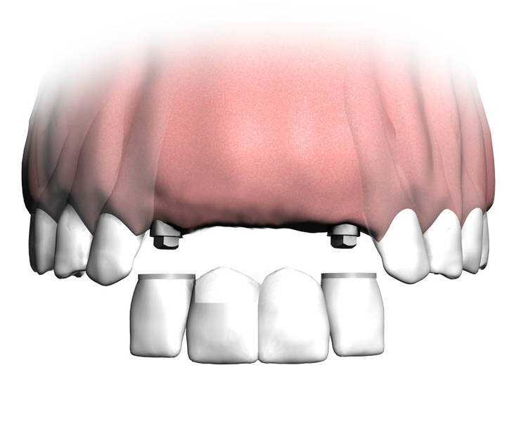 Welcher Zahnersatz wann: Brücke, Prothese oder Implantat?