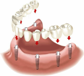 Preis für Feste Zähne auf 6 Implantaten