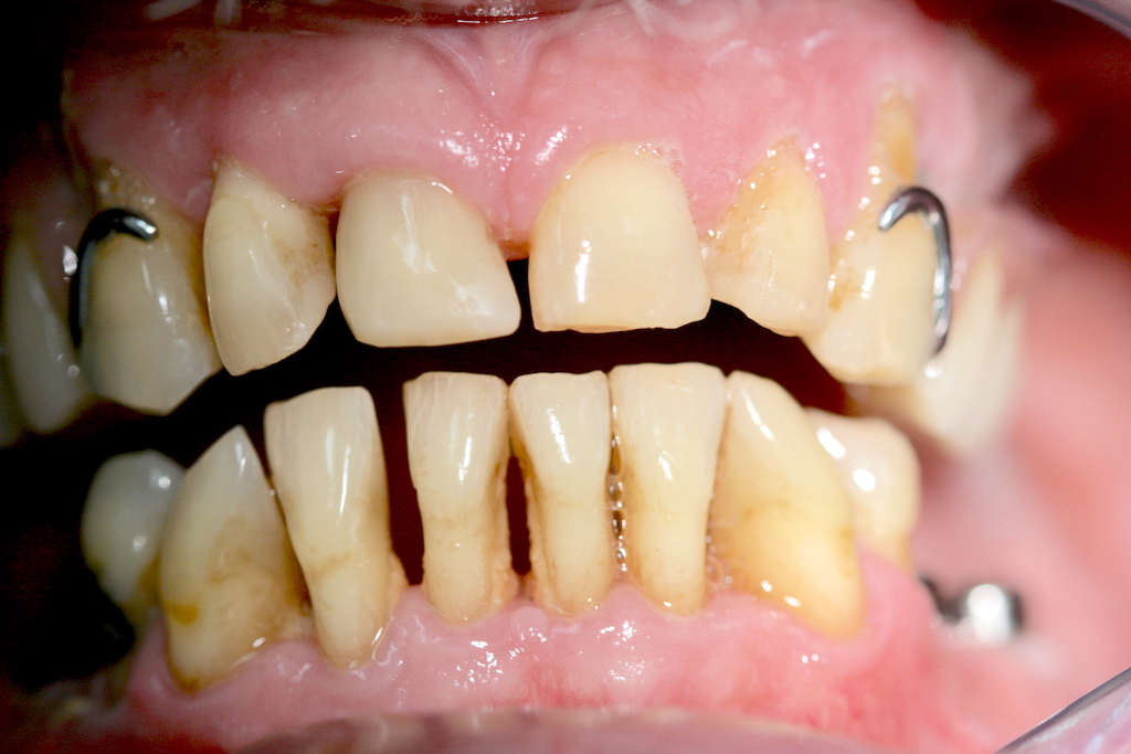 Oberkiefer erfahrungen klammerprothese Zahnbehandlung Ungarn
