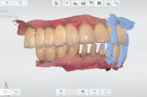 Intraoralscan beider Kiefer und Biß