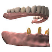 Beihilfe Erstattung Implantat