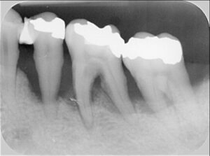 Zahnröntgenaufnahme von drei Zähnen, mit sichtbaren Füllungen und Zahnersatz. Das Bild zeigt die Wurzeln und strukturellen Details, wahrscheinlich verwendet für zahnärztliche Untersuchungen und Diagnosen.