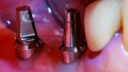 Nahaufnahme von zwei im Zahnfleisch eingebetteten Implantaten, wobei rechts ein natürlicher Zahn zu sehen ist. Der Zahnersatz hat eine metallische Oberfläche und ist von rosa Zahnfleischgewebe umgeben, was fortschrittliche Zahntechnologie veranschaulicht.