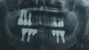 Ein zahnärztliches Röntgenbild zeigt mehrere Implantate und Zahnersatz und zeigt Ober- und Unterkiefer mit mehreren Zähnen und Implantaten auf beiden Seiten. Das Bild hebt die komplexe Knochenstruktur und die präzise Platzierung dieser anspruchsvollen Zahnarbeit hervor.