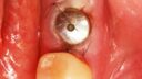 Nahaufnahme eines Zahnimplantats im Unterkiefer. Das Implantat ist fest im Zahnfleischgewebe verankert und von natürlichen Zähnen umgeben. Nähte sind sichtbar, was auf eine kürzlich erfolgte chirurgische Platzierung hinweist. Der Zahnersatz erscheint cremefarben, während das Zahnfleisch rosa bleibt.