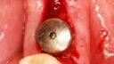 Eine Nahaufnahme eines Zahnimplantats (Implantat) im Unterkiefer, umgeben von natürlichen Zähnen. Dieser metallische Zahnersatz ist inmitten von Zahnfleischgewebe verankert, das eine frische chirurgische Rötung aufweist.