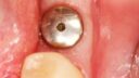 Nahaufnahme eines Zahnimplantats oder Zahnersatzes im Zahnfleisch einer Person, wobei die umliegenden Zähne sichtbar sind. Der metallische Implantatpfosten ist in das rosa Zahnfleischgewebe eingebettet und bereitet die Befestigung einer Krone vor.
