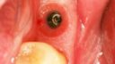 Nahaufnahme eines Zahnimplantatpfostens (Implantat), der im Zahnfleischgewebe sichtbar ist, umgeben von natürlichen Zähnen. Der Bereich erscheint sauber und rosa, was auf gesundes Mundgewebe um die Zahnersatzstelle hinweist.