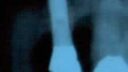 Ein zahnärztliches Röntgenbild zeigt den Oberkiefer mit einem Metallpfosten als Zahnersatz und mehreren sichtbaren Zähnen. Das Bild ist dunkel, wobei der Metallpfosten und das Implantat deutlich hervorgehoben werden.