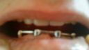 Eine Nahaufnahme des Mundes einer Person mit einem Metalldrahthalter über den Zähnen, der an komplizierten Zahnersatz erinnert. Die Lippen sind teilweise geöffnet und die Finger halten den Halter an Ort und Stelle.
