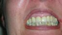 Nahaufnahme einer Person, die ihre Zähne in einem übertriebenen Lächeln zeigt. Dabei werden nicht nur die lebhafte Hautstruktur und Lippenform hervorgehoben, sondern auch Zahnimplantate und Zahnersatz ins Rampenlicht gerückt, die durch den Fokus auf die untere Gesichtshälfte aufwendig hervorgehoben werden.