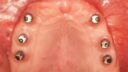 Eine Nahaufnahme des Oberkiefers zeigt sechs in das Zahnfleisch eingebettete Implantate, die in einer geschwungenen Linie entlang des Gaumens angeordnet sind. Die metallischen Implantate bilden einen lebhaften Kontrast zum rosafarbenen Gewebe des Mundes und stellen eine fortschrittliche Form des Zahnersatzes dar.