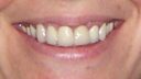 Eine Nahaufnahme des lächelnden Mundes einer Person, bei der Zähne und Lippen sichtbar sind, unterstreicht die Schönheit des Zahnersatzes. Das Bild konzentriert sich auf die untere Gesichtshälfte und betont die Zahnästhetik.