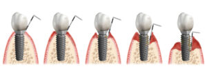 Periimplantitis Diagnose