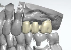 CAD/CAM Zahnbrücke