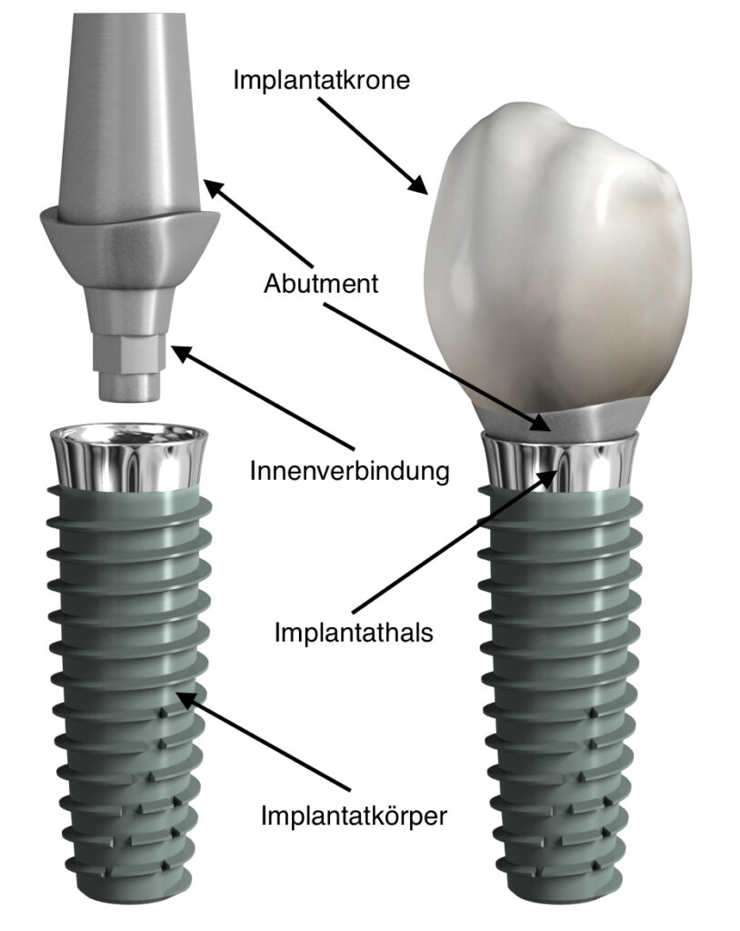 Zweiteiliges Implantat