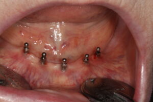 5 Miniimplantate