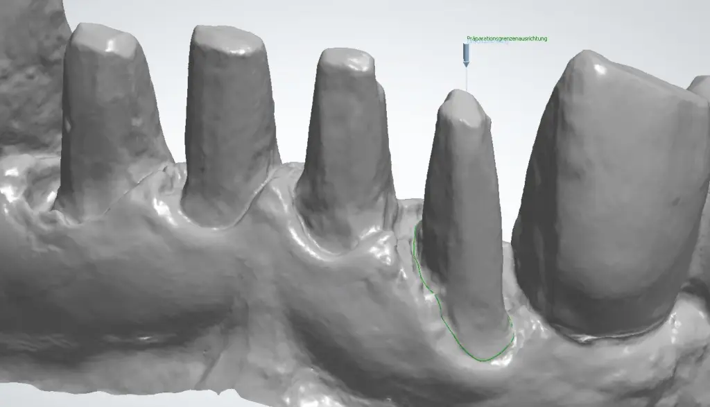 CAD/CAM Zahnstümpfe mit erkennbarer Präparationsgrenze im digitalen Scan