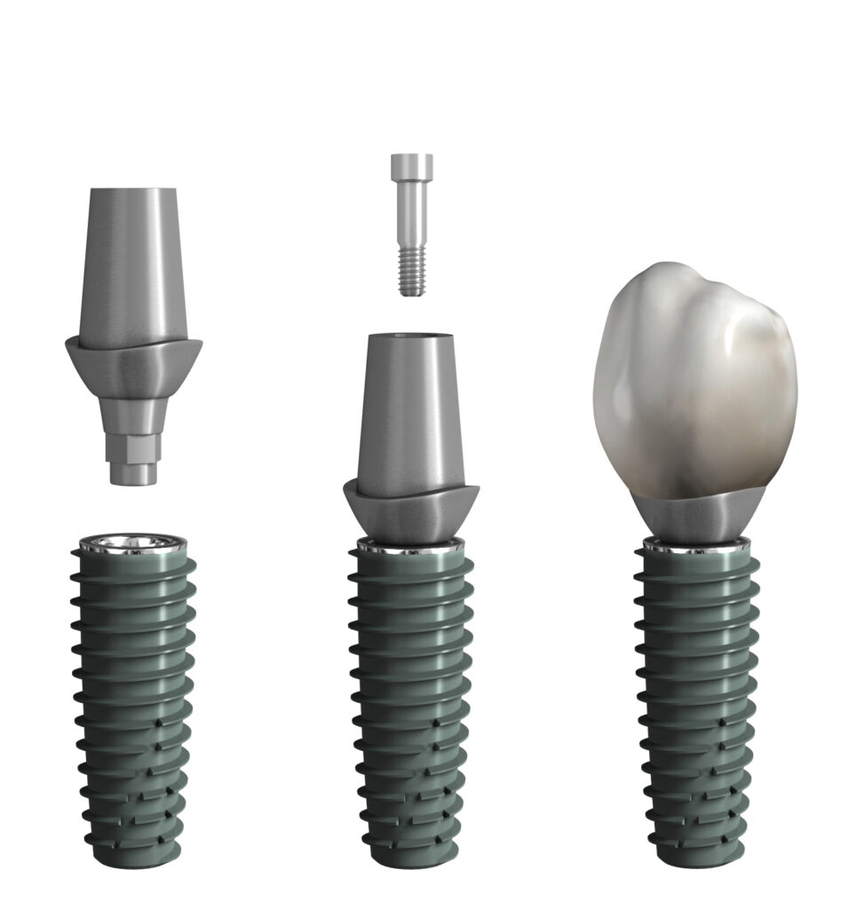 Zementierte Implantatkrone: Implantat, darauf verschraubtes Titanabutment und die auf dem Abutment zementierte Krone