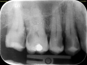 Zahnfilm (Einzelzahnröngen)  mit kariösen Zahnen