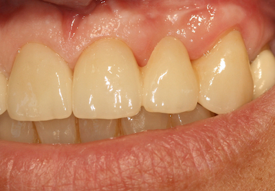 Gesundes Zahnfleisch: straff, blas-rosa