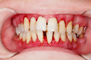 Schwere Zahnfleischentzündung (Gingivitis) Leukozytenadhäsionsdefizienz