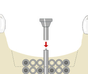 Distraktor für Knochenaufbau