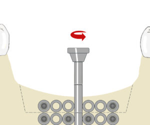 Distraktor Drehscgraube