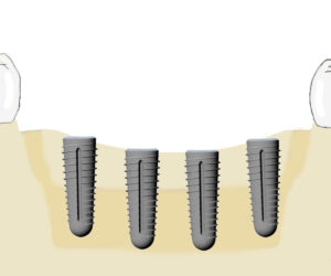 Implantate im Knochenaufbau