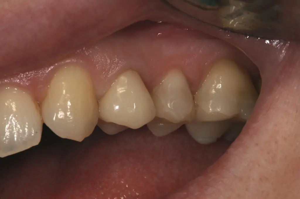 Gesunde, blassrosa Gingiva ohne Blutung nach dem Sondieren – Beispiel für einen BOP-negativen Befund