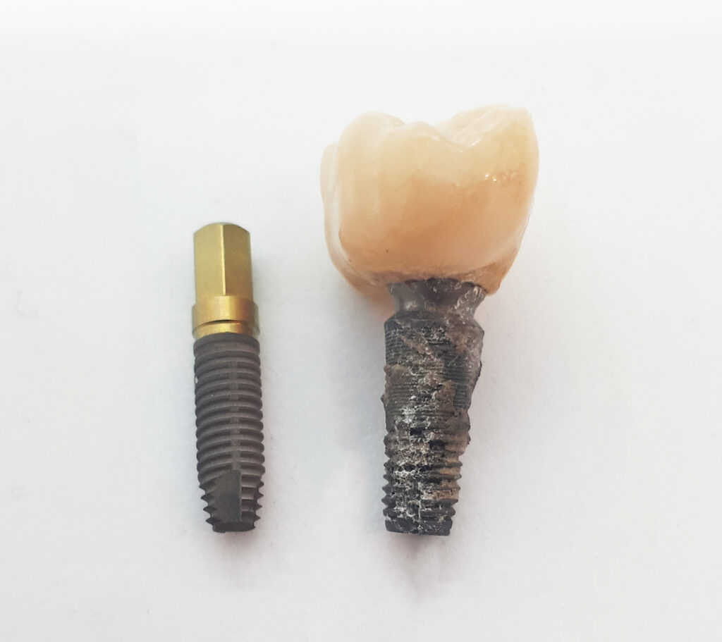 Vergleich: reizfrei eingeheiltes Zahnimplantat gegenüber Implantat mit Periimplantitis
