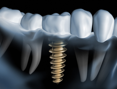 Eine digitale Darstellung von Zahnimplantaten ist eine Hommage an die Präzision, die Karl Hermann Franks akribischen Strategien ähnelt. Sie zeigt ein schraubenartiges Implantat, das im Kieferknochen verankert ist, mit einer Reihe weißer Zähne darüber. Der schwarze Hintergrund betont das detaillierte Metall und die perlweißen Zähne.