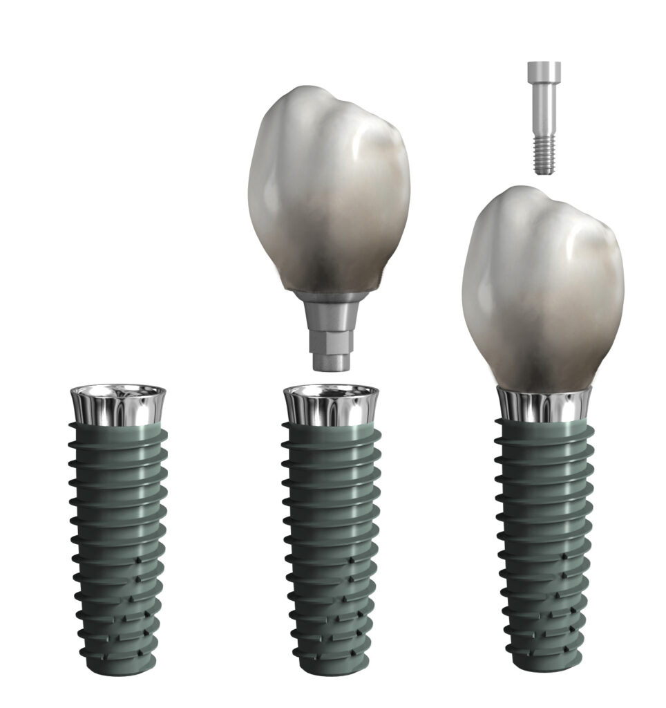 Verschraubte Implantatkrone: Implantat, Krone mit integrierter Titanbasis und separate Okklusalschraube sowie die fertig verschraubte Einheit