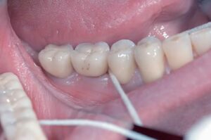 Zahnseide in der Inderdentalpflege