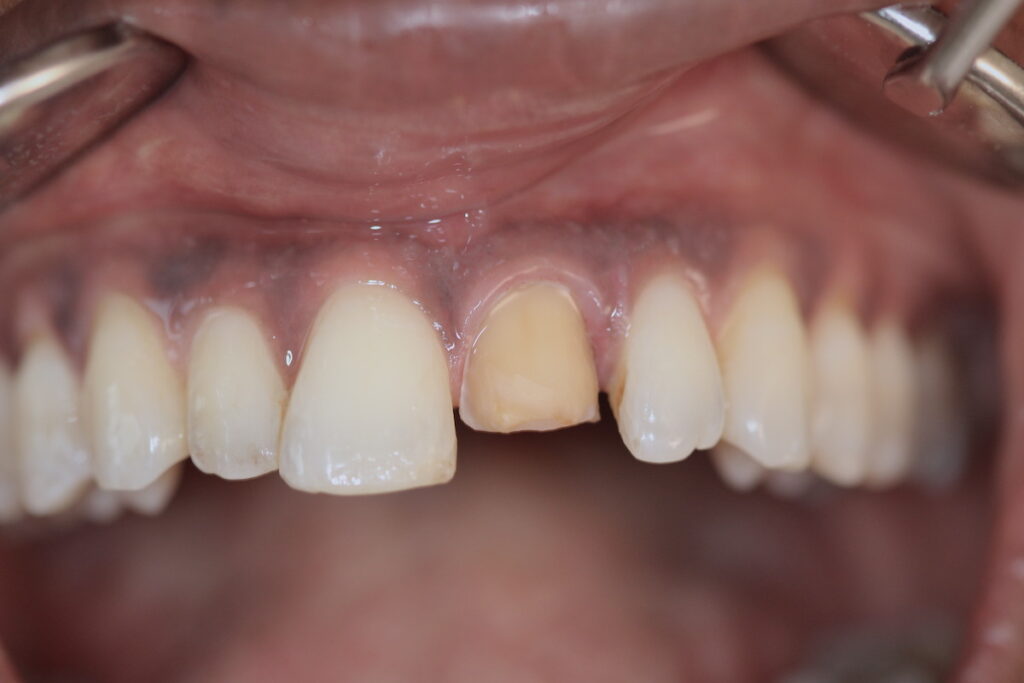 Frontzahn mit Zahnschmelz; der anere Abtrag (Beschleifen): Dentin sichtbar