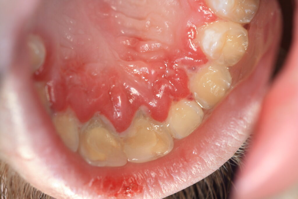 Gingivo-Stomatitis-aphtosa-NUP-ANUG