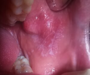 Lichen planus Wickham Zecihnung