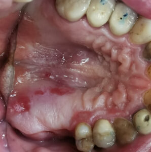 Soor-Stomatitis Gaumen
