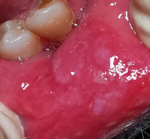Mundsoor der Lippe orale Candidiasis