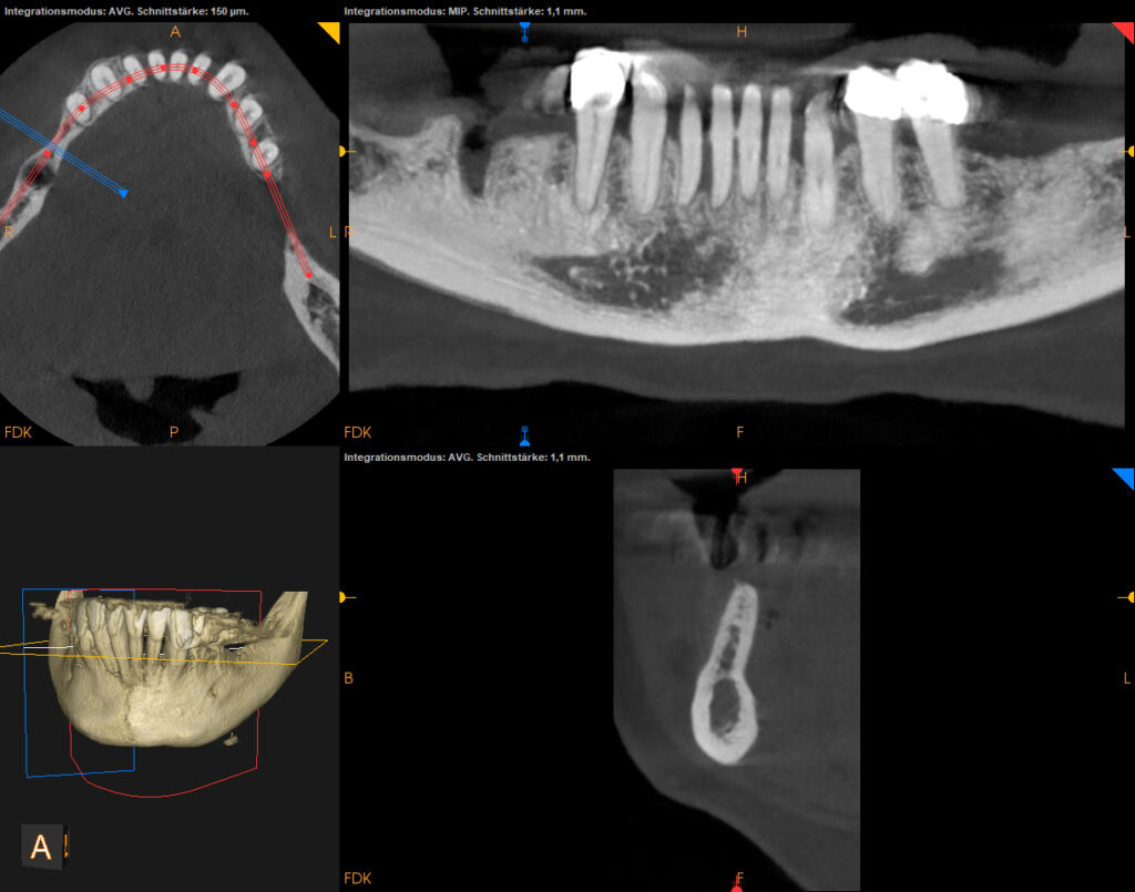 DVT digitale Volumentomographie 3D-Röntgen Planung Atrophie