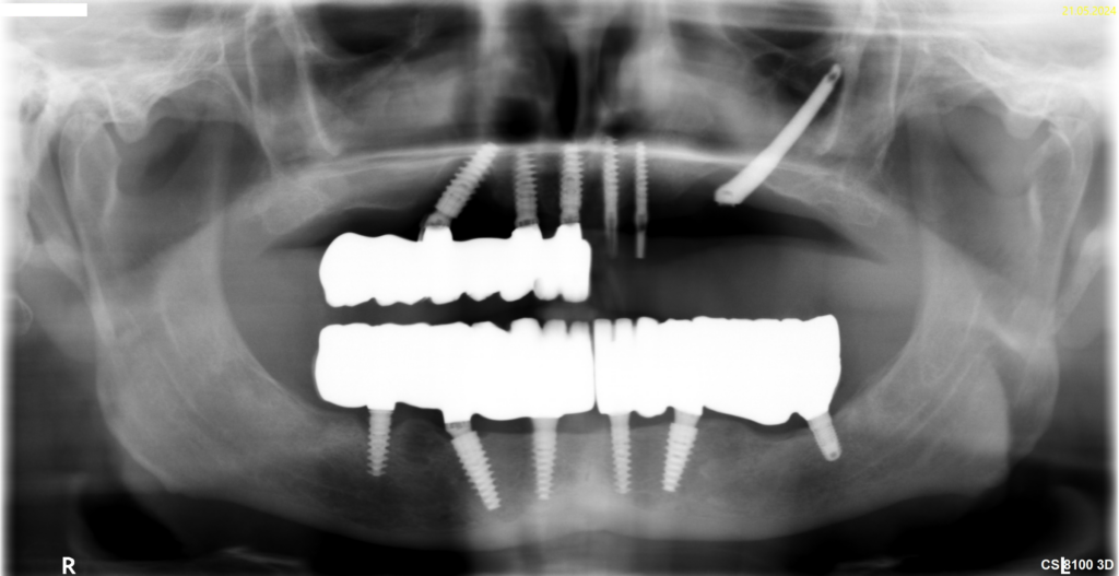 Zygoma-Implantat