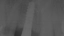 Ein Röntgenbild zeigt Zahnimplantate (Implantate) und die umliegenden Zähne und verdeutlicht den Zahnersatzprozess. Eine sichtbare Schraube deutet auf das Implantat inmitten teilweise sichtbarer natürlicher Zähne hin. Das Graustufenbild akzentuiert Zahnstrukturen und ihre Positionierung.