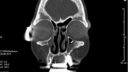 CT-Scan-Bild eines menschlichen Schädels, das eine Frontalansicht der Nebenhöhlen und der Nasenhöhle zeigt. Die verschiedenen Knochen, Lufthöhlen und möglichen Bereiche für Implantate sind sichtbar, mit einigen medizinischen Anmerkungen an den Seiten des Bildes.