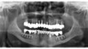 Ein zahnärztliches Röntgenbild, das den gesamten Mund zeigt, einschließlich Ober- und Unterkiefer. Sichtbar sind mehrere Implantate, Zahnersatz wie Brücken und Kronen. Das Bild hebt die Zahnausrichtung und die Knochenstruktur hervor.