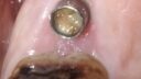 Nahaufnahme eines zahnärztlichen Eingriffs, bei dem ein Implantat im Mund einer Person zu sehen ist. Das Bild konzentriert sich auf eine zylindrische Metallkomponente, die als Zahnersatz fungiert und in Zahnfleischgewebe eingebettet ist. Ein weiteres Werkzeug ist teilweise sichtbar. Der Bereich erscheint feucht.