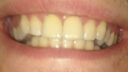 Eine Nahaufnahme eines lächelnden Mundes zeigt gelbliche Zähne, von denen einige Zahnersatz aufweisen. Die Zähne sind innerhalb der leicht geöffneten Lippen ausgerichtet und zeigen ein warmes, natürliches Lächeln.